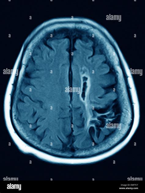 CEREBRAL ATROPHY, MRI Stock Photo - Alamy