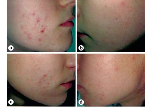 Figure 3 from Azelaic Acid in the Treatment of Acne in Adult Females ...