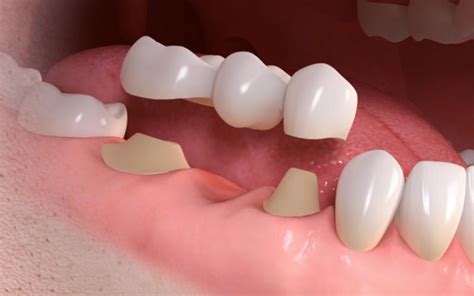 Prosthodontics - False Teeth Replacement with Dentures, Bridges