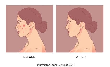 146 Before After Acne Treatment On Beige Images, Stock Photos & Vectors ...