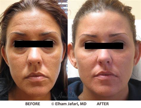 Liquid Facelift - Cosmetic Treatments in Irvine, Orange County