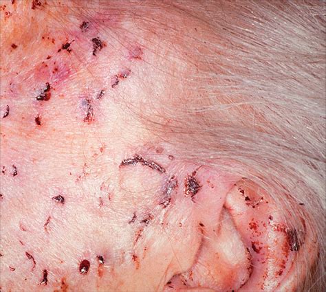 Sharply Demarcated Incisions Caused by Rat Bites | Dermatology | JAMA Dermatology | JAMA Network