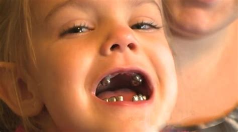 Mom shocked to find mouth of silver after 4-year-old's dental visit ...