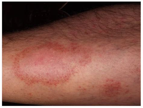 JCM | Free Full-Text | Pigmented Purpuric Dermatoses: A Complete Narrative Review