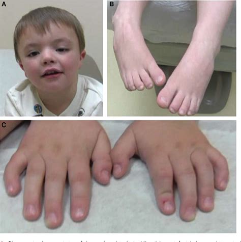 Figure 1 from A novel FGD1 mutation in a family with Aarskog–Scott syndrome and predominant ...