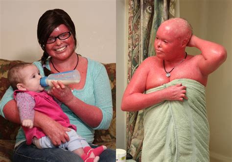 Harlequin Ichthyosis Stephanie Turner