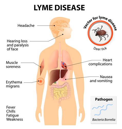 Ignore Lyme Disease Symptoms and You Could Risk Severe Complications ...