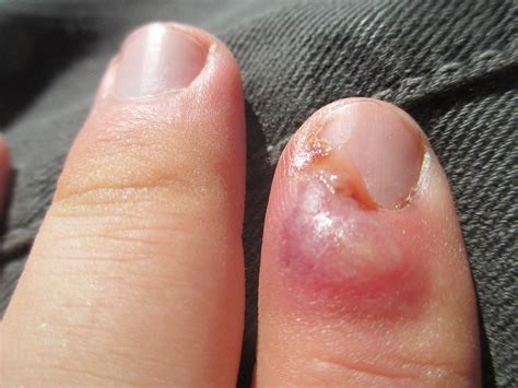 ingrown fingernail – Richard T. Reilly