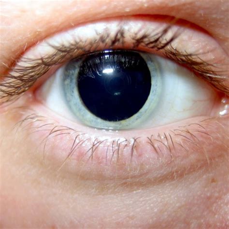 Mydriasis (Dilated Pupils): Causes And Treatment, 42% OFF