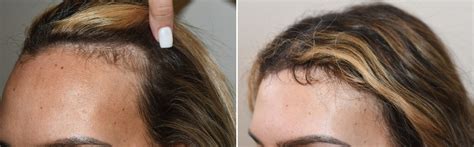 Forehead Reduction Surgery photos | Miami, FL | Patient125944