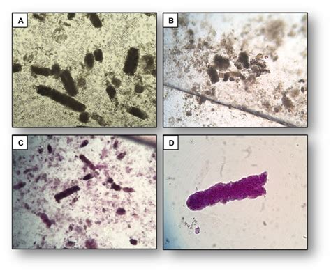 Urine Sediment of the Month: Granular & "Muddy Brown" Casts - Renal ...