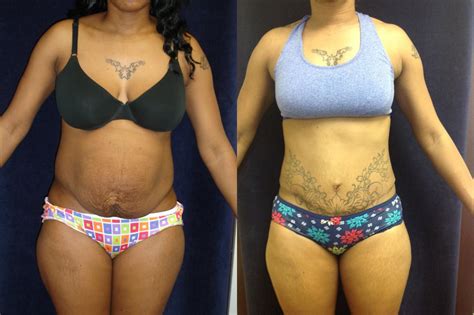 Tummy Tuck Before & After Photos Patient 137 | San Francisco, CA | Kaiser Permanente Cosmetic ...