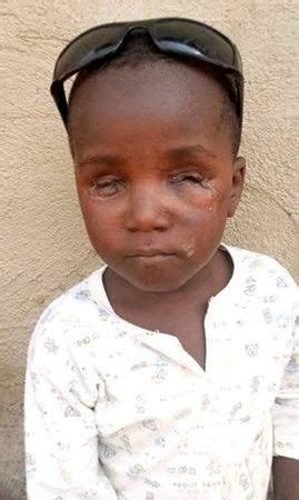 Checkout New Photos Of The 3-Yr-Old Boy Whose Eyes Were Plucked Out By Ritualists In Zaria ...