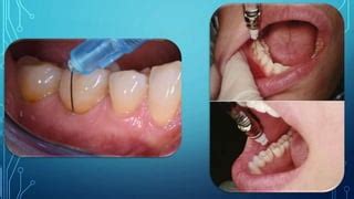 Dental Anesthesia Dental Anaesthesia Techniques & Complications | PPT