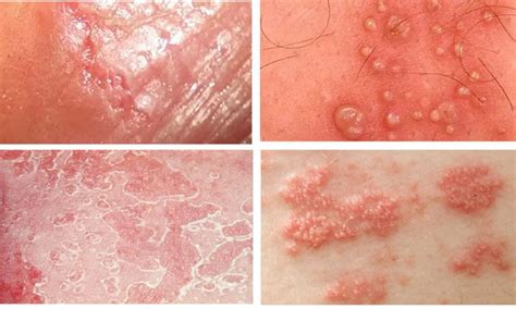 Candida balanoposthitis: causes, symptoms and treatment | Health 2024