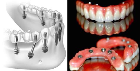 What is Basal Dental Implant? - Senthil Dental Clinic