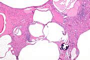 Autosomal dominant polycystic kidney disease - Libre Pathology