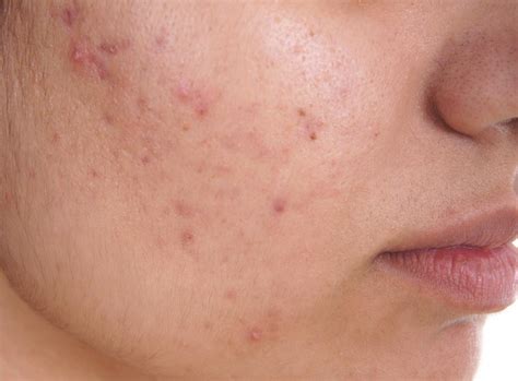 Does Food Cause Acne? The Truth About Acne And What Causes It Does Food Cause Acne? - Celeb And ...