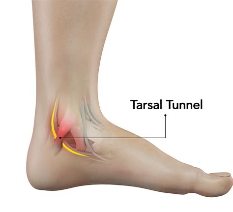 Tarsal Tunnel Syndrome Pasadena | Posterior Tibial Neuralgia Glendale