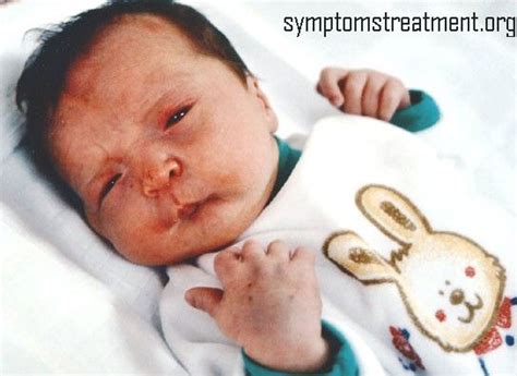 Pierre Robin Syndrome-Pictures, Symptoms, Treatment