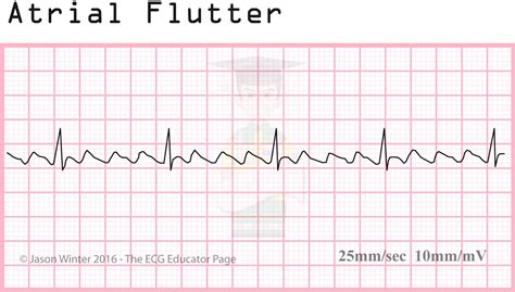 ECG Educator Blog : Atrial Rhythms