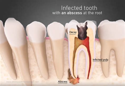 Wisdom Tooth Cyst On Gum