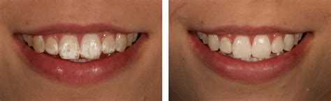 Emily - Icon white spot treatment and Enlighten whitening - Central London W1, UK - Harley ...