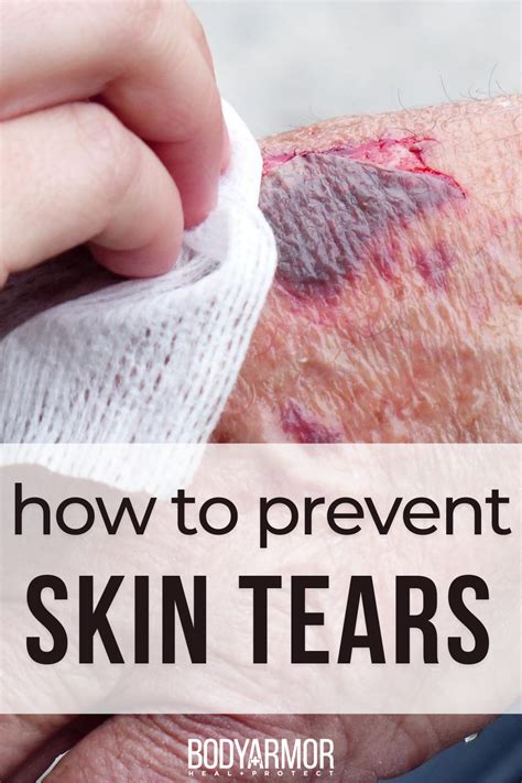 10 Steps for Skin Tear Prevention | BODYARMOR MEDICAL SUPPLIES | Home health care, Wound care ...