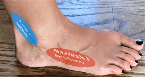Peroneal Tendonitis - Almawi Limited The Holistic Clinic