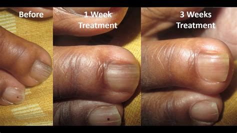 Nail Fungus Treatment Before and After: Week 2 to 3 - YouTube