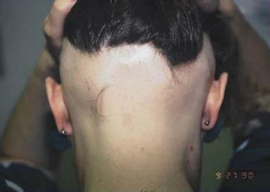 Ophiasis Alopecia: Causes, Symptoms and Treatments - Wimpole Clinic