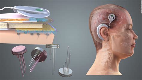 Brain implants could give governments and companies power to read your ...