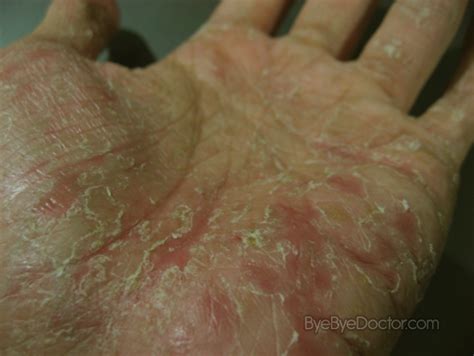 Dyshidrotic Eczema – Pictures, Causes, Home Remedies, Treatment ...