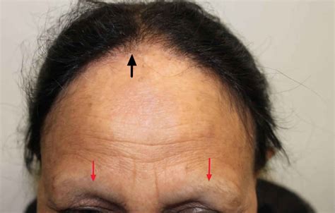 Frontal fibrosing alopecia causes, symptoms, diagnosis, treatment & prognosis