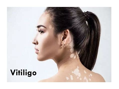 PPT - Vitiligo: Causes, Treatment, Diet in Ayurveda PowerPoint Presentation - ID:10589018