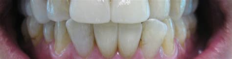 Emax crowns 11,21,31,41 post-tx - Jaya Dental Surgery