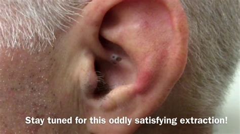 Blackhead Inside Ear