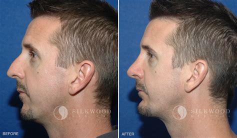 Chin Implant Before And After