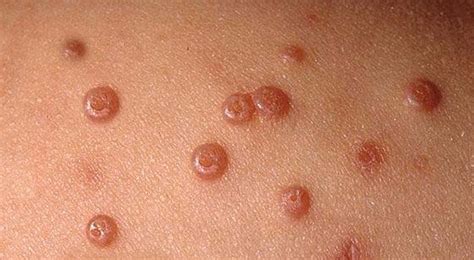 Molluscum Contagiosum: To treat or not to treat? | Dermcast.tv