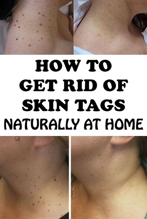 How to Get Rid of Skin Tags Naturally at Home | Remove skin tags ...