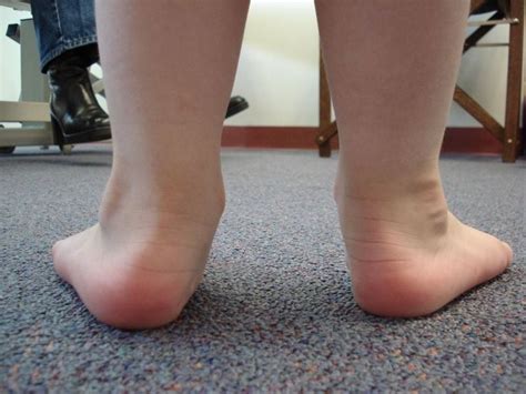 Flat Feet St. Catharines Ontario, Canadian Foot Clinic & Orthotic Centre