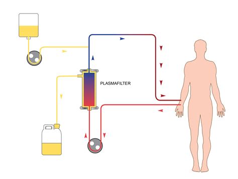 Double Filtration Plasmapheresis | Immune Cells 21