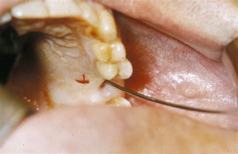 Fistula Bucal