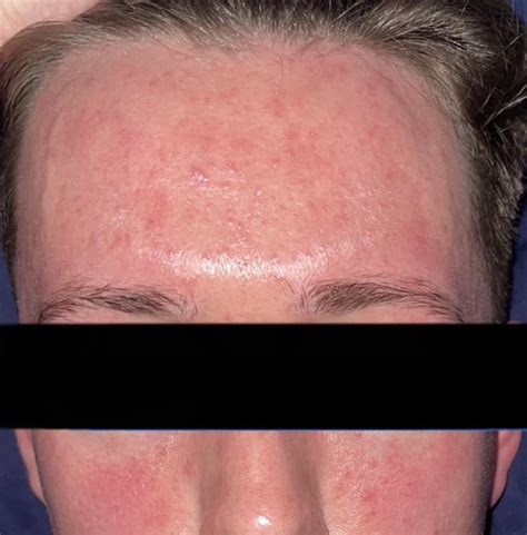 Doxycycline 100mg : r/Rosacea