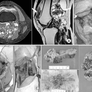 (PDF) Outcomes of Diffuse-Type Pigmented Villonodular Synovitis (PVNS) after Open Total Synovectomy