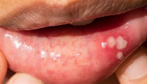 Canker sore vs. oral cancer: 3 key differences | MD Anderson Cancer Center