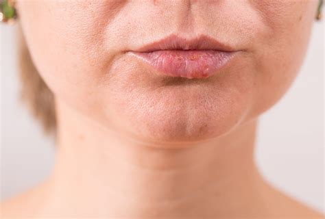 What Causes White Bumps on Lips & How to Treat It?