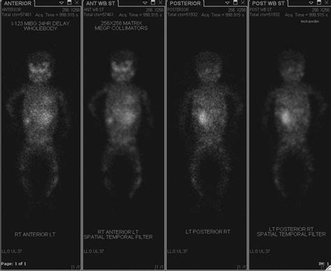 Whole-body MIBG scan upon presentation shows extensive uptake in the... | Download Scientific ...