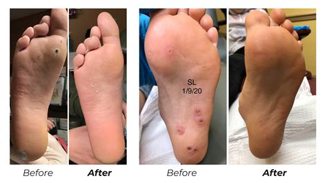 Verruca Plantaris Treatment