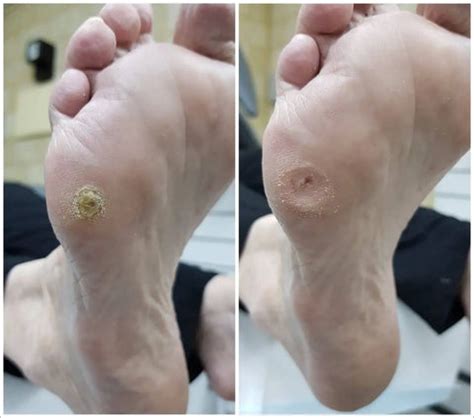 Callous & Corns On Feet: Similarities To Blisters